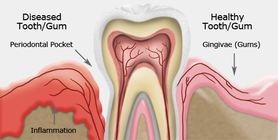 disease periodontal