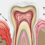 disease periodontal