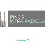 Pinos Intrarradiculares