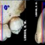 2 molar arco dentario