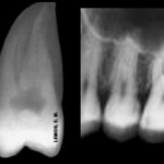 2 molar radiografia