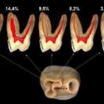 2 molar raiz mesiovestibular