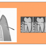 cirurgia ressectiva