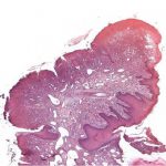 granuloma