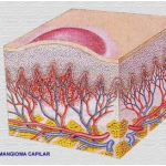 hemangioma