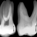 molar radiografia