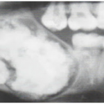 odontoma complexo
