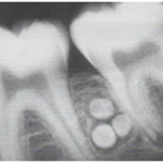 odontoma composto