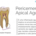 pericementite