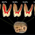 raizes mesiovestibular 1MS