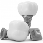 dental-implants