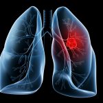 lung1